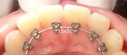 裏側ワイヤー部分矯正の治療後（症例写真）