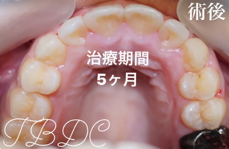 歯科矯正-ビフォーアフター症例写真-矯正後-部分矯正プラス＋-前歯の部分矯正