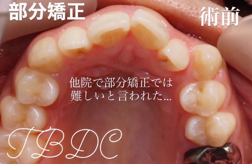 歯科矯正-ビフォーアフター症例写真-矯正前-部分矯正プラス＋-前歯の部分矯正