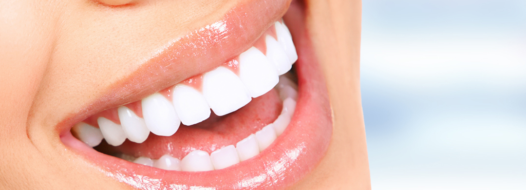 セラミック矯正