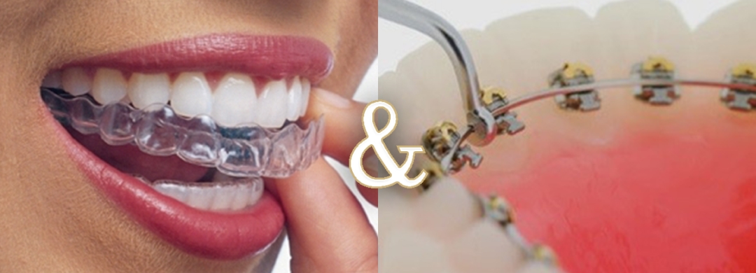 コラボ矯正（マウスピース矯正×ワイヤー矯正）イメージ画像