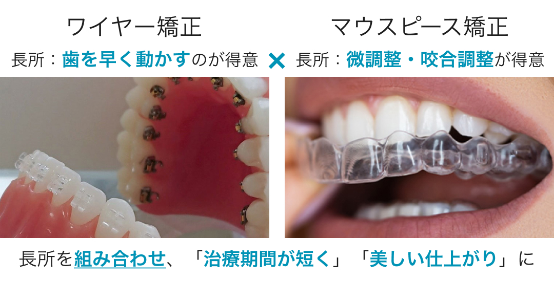 コラボ矯正(ワイヤー矯正＆マウスピース矯正)の説明