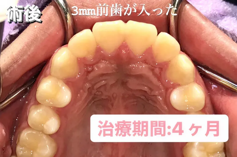 歯科矯正-ビフォーアフター症例写真（マウスピース部分矯正プラス-出っ歯・前歯の部分矯正）