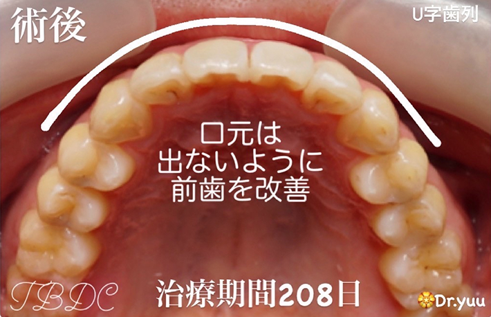 歯科矯正-ビフォーアフター症例写真-矯正後-マウスピース矯正（インビザライン）-ねじれ・ガタつき・横顔・噛み合わせ