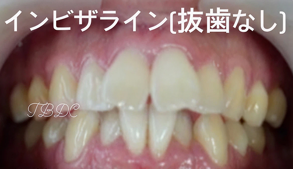 歯科矯正-ビフォーアフター症例写真-矯正前-マウスピース矯正（インビザライン）-ねじれ・ガタつき・横顔・噛み合わせ