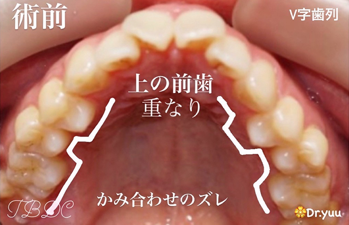 歯科矯正-ビフォーアフター症例写真-矯正前-マウスピース矯正（インビザライン）-ねじれ・ガタつき・横顔・噛み合わせ