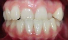 歯科矯正-ビフォーアフター症例写真-矯正前-マウスピース矯正（インビザライン）-上下の前歯の前後関係が逆になっていた歯並び