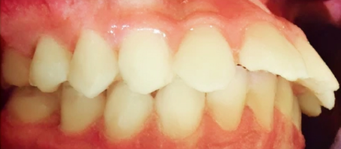 歯科矯正-ビフォーアフター症例写真（マウスピース矯正-出っ歯）