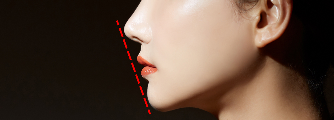 口ゴボ矯正(Eライン・横顔矯正)のイメージ写真