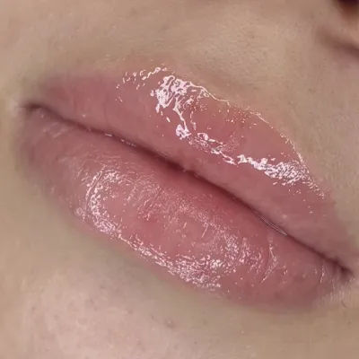 1回目施術から1ヵ月後