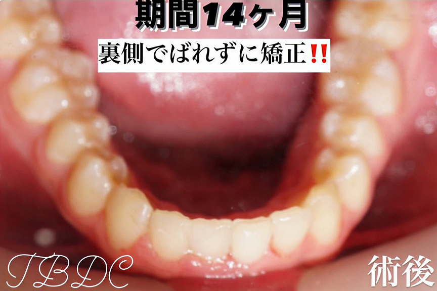 歯科矯正-ビフォーアフター症例写真-矯正後-コラボ矯正（マウスピース矯正×ワイヤー）-歯のガタつき