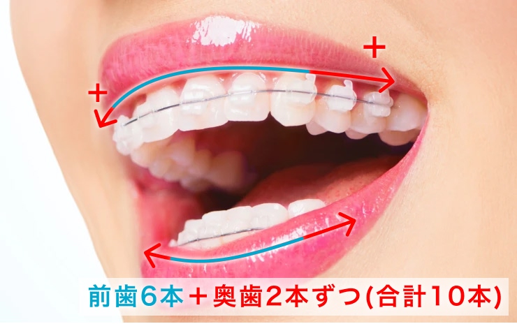 ワイヤー矯正