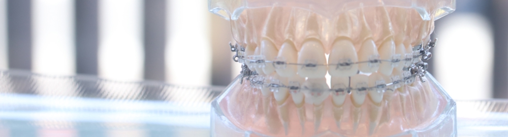 表側ワイヤー矯正（透明）